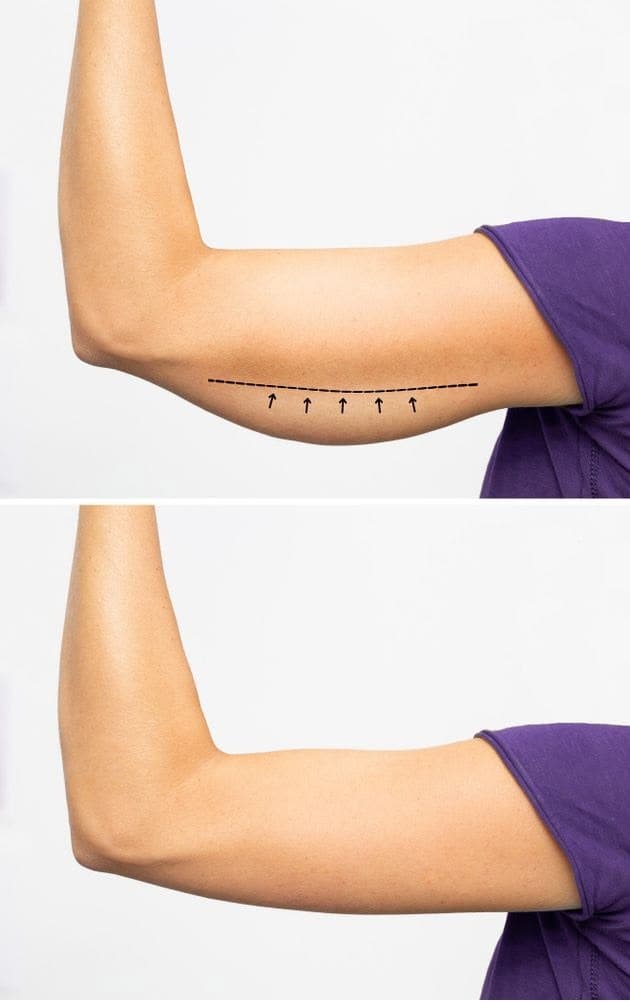 Barbie Arms (Mesolipo Arms)