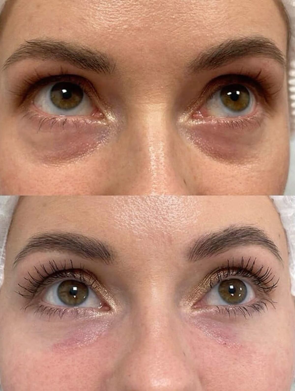 Eyebags Removal