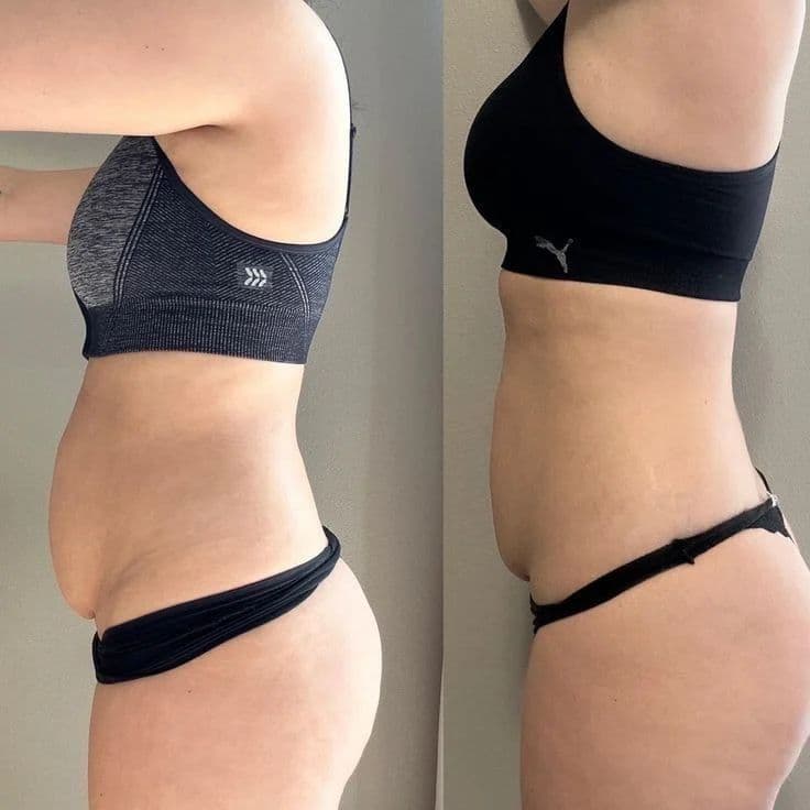 Tummy Lipo (Mesolipo Tummy)