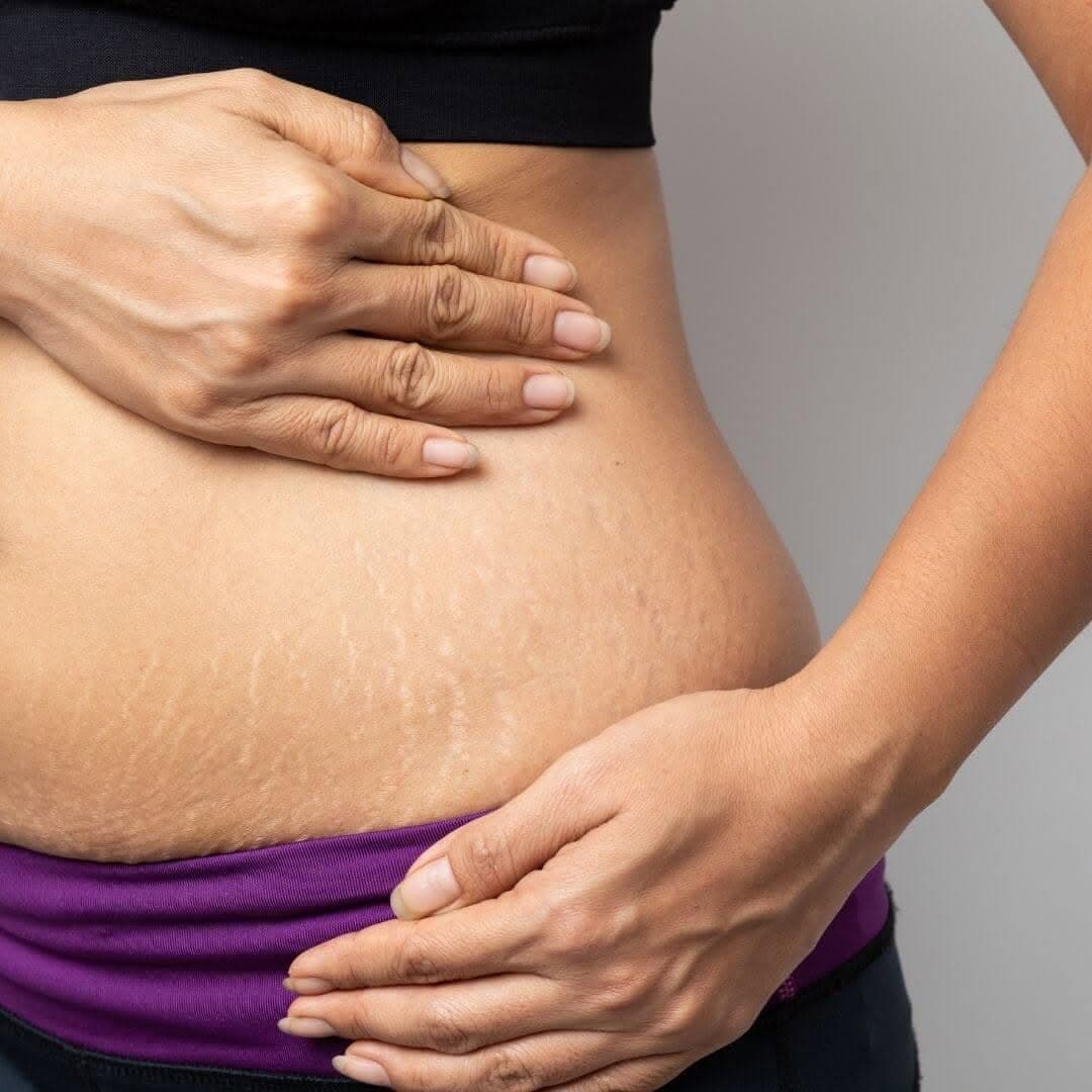 Tummy Stretchmark Minimizer