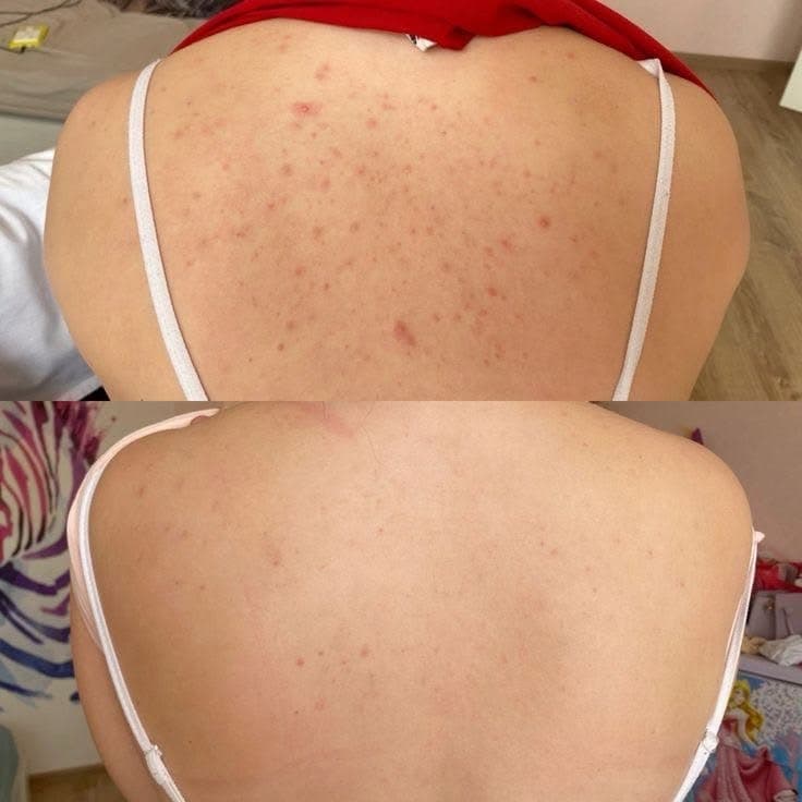 Back Microneedling