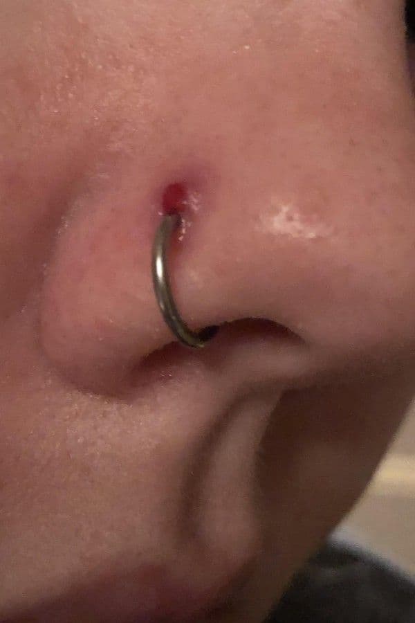 Jewelry Removal (Infected)