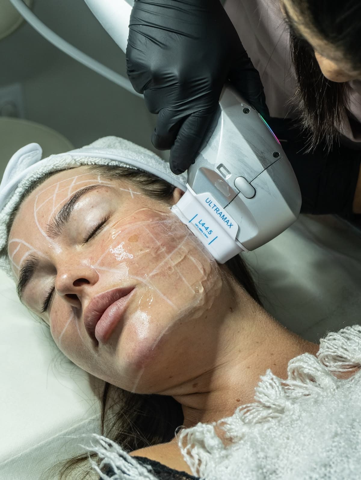 Supreme HIFU Treatment