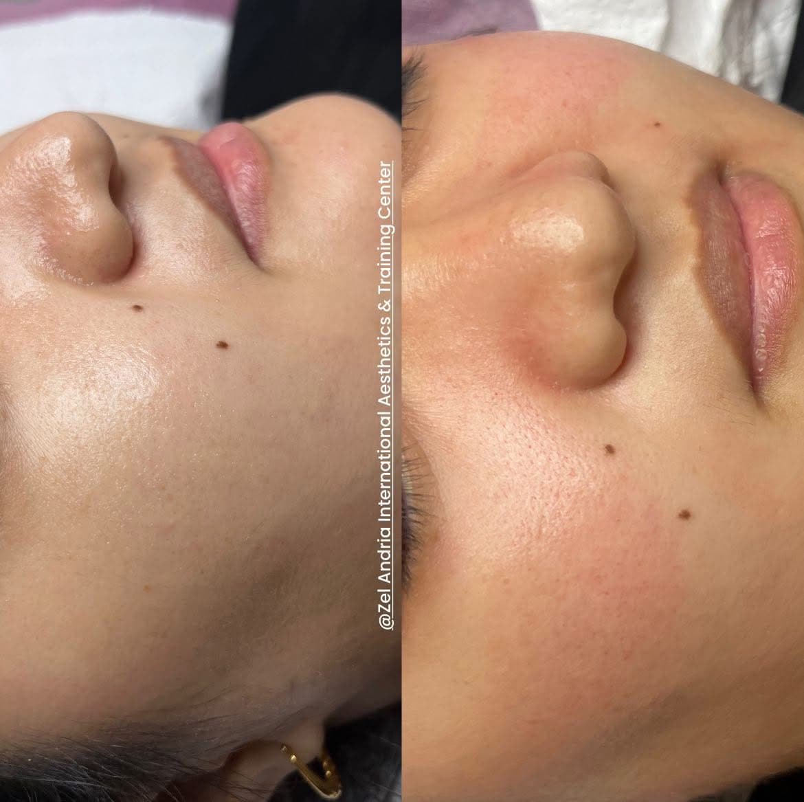 Warts Removal